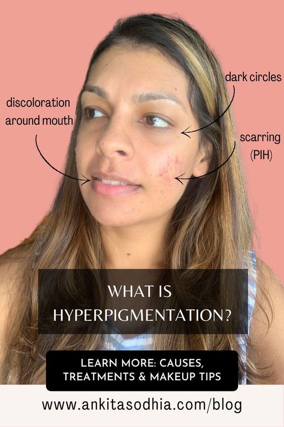 Hyperpigmentation: Everything You Need To Know About